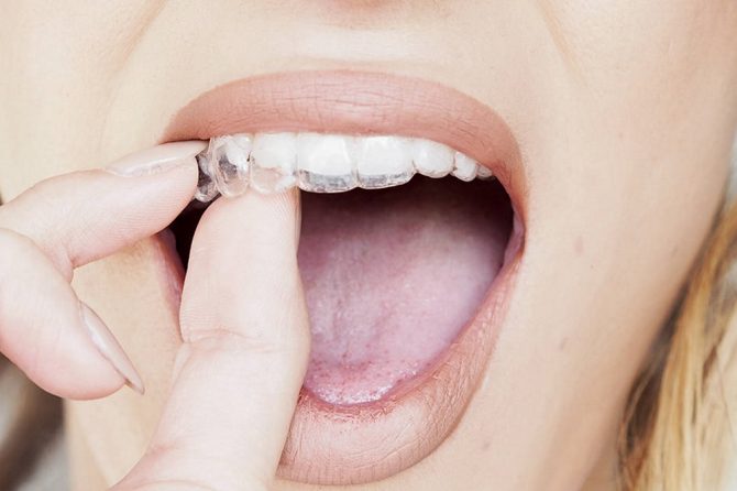 ¿Cómo lavar tus férulas Invisalign?