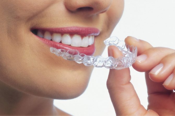 Ventajas de Invisalign frente a otros tipos de ortodoncia