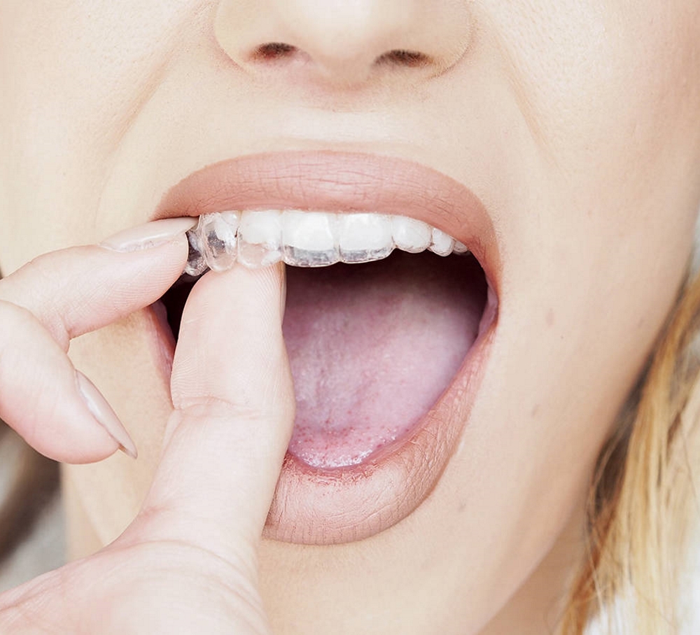 ortodoncia Invisalign en Almería